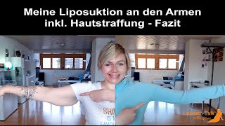 Meine Liposuktion an den Armen inkl chirurgischer Hautstraffung  Fazit [upl. by Orelie928]