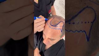 Hair Transplant may be the perfect solution for you vincihairclinic shorts [upl. by Enidlarej591]