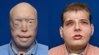 Volunteer Firefighter Receives Most Extensive Face Transplant In History [upl. by Malliw]