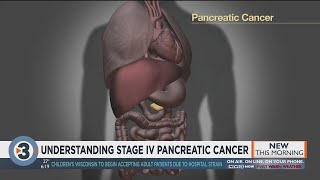 Understanding stage IV pancreatic cancer [upl. by Berget731]