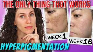 The ONLY Ingredients That Stop Hyperpigmentation And Reverse It [upl. by Eiluj703]