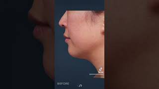 Submental Liposuction amp Chin Augmentation Before and After  JawDropping Results [upl. by Esertal]