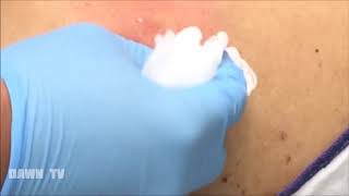 PIMPLE POPPING ON BACK PART 8 OF 8 [upl. by Templas851]