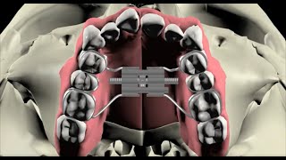 Are maxillary palatal expanders overused [upl. by Boigie]