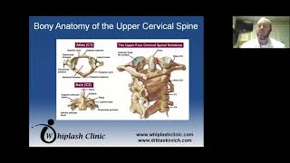 Understanding Complexities in Whiplash Trauma From Ligament Injuries to Motion XRay Insights [upl. by Noreh]