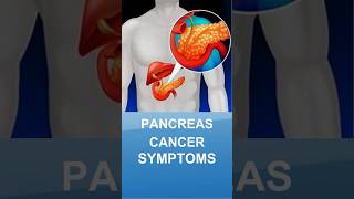 Symptoms of pancreas cancer 7428617074 [upl. by Ellata]