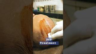 After hair PRP treatment hairecare short viralvideo explorepage [upl. by Baggott]