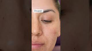 Aplicación de Ácido Hialuronico en Ojeras 😨✔ skincare derma botox ácidohialurônico filler [upl. by Moscow]