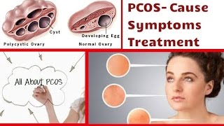 PCOS Treatment in Hindi Paiye Mahilao ke Liye Behatrin Ilaj [upl. by Yrol]