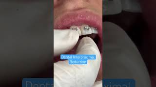 Filing TeethIPR Orthodontic Treatment orthodontics braces orthodontist ipr [upl. by Eddra]