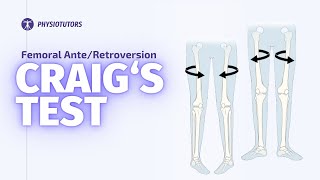 Craigs Test  Femoral Anteversion [upl. by Cerellia]