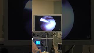 Dr Mora Pimple Popper Of the Shoulder Calcific Tendinitis Treatment [upl. by Etnohc]