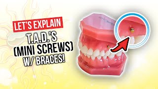 How Long Will You Need TADs With BRACES For [upl. by Laughlin]