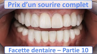 Prix Facette dentaire pour un sourire complet  Guide complet Facette dentaire  partie 10 [upl. by Killigrew65]