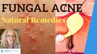 FUNGAL ACNE  MALASSEZIA FOLLICULITIS  NATURAL REMEDIES [upl. by Naples]