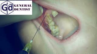 Infiltration anesthesia for extraction 12 tooth [upl. by Annaohj]