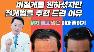 비절개모발이식을 절개식으로 권해드린 이유 M자탈모 이마높이 낮추기 [upl. by Attenwad]