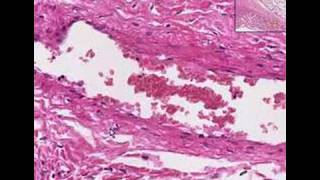 Histopathology Lung pleura Adhesion [upl. by Refinej]