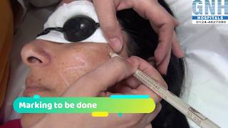 Treatment of Melasma amp Hyperpigmentation at GNH Hospital Gurgaon [upl. by Ojybbob]