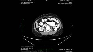 interesting CT image [upl. by Ogren812]