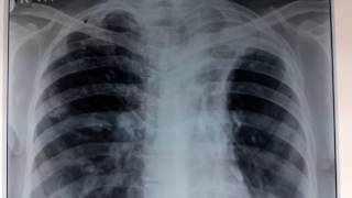 Lung Collapse on Left Side  Shifting of Trachea towards Left Side  Lung Disease [upl. by Avirt1]