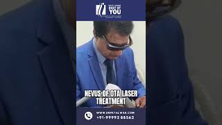 Nevus of OTA Laser Treatment  Birthmark Removal Treatment  Dr PK Talwar [upl. by Corry]