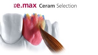 IPS emax Ceram Selection [upl. by Ffoeg]