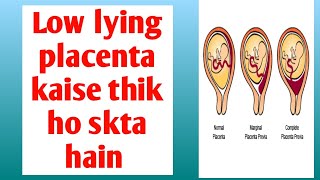 low lying placenta कैसे ठीक हो सकता है low lying placenta risk and precautions [upl. by Al332]