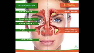 Sinuzite si rinosinuzite  Paula Pascu Bejenaru medic specialist ORL [upl. by Raamal]