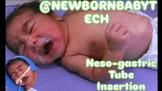 Nesogastric NG tube Insertion in neonatenewborn orogastric OG tube neonate feeding tube [upl. by Linetta]