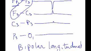 Correct Electrode Placment  10 20 System Electrode Placement EEG [upl. by Ijic510]