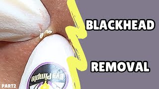 Blackheads extractionRelax with bye pimple💜pimple blackheads acnetreatment asmr [upl. by Kristoforo792]