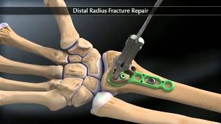 Arthrex Distal Radius Fracture Fixation [upl. by Aicnorev]