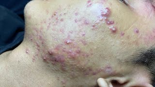 ACNE TREATMENT VU QUYNH MI Blackheads On Boy Face 2024 [upl. by Novia]