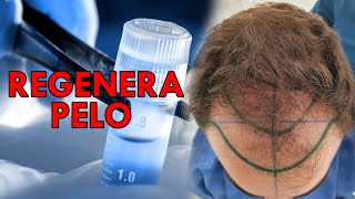 Recupera tu pelo sin injerto ni pastillas explicado por médico [upl. by Ayanad455]