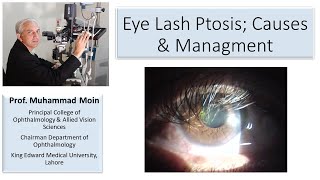 Eyelash Ptosis Causes amp Managment [upl. by Sucramel858]