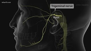 Trigeminal Neuralgia local doctors may have found the cure [upl. by Siri672]