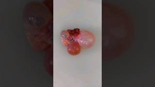 Polycystic ovary grossing video  histopathology uterinefibroid cystitis placentahistology tb [upl. by Eanrahc]