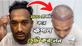 কপাল ছোট করলেন  ১৪০০ গ্রাফট হেয়ার ট্রান্সপ্লান্ট  Hair Transplant Bangladesh hairtransplant [upl. by Anirpas]