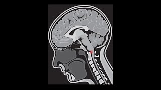 Kraniozervikale Instabilität bei EDS  Craniocervical Instability in EDS [upl. by Dewie]