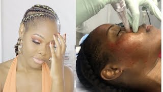 Microneedling Before and After on Dark Skin  GRWM [upl. by Zindman]