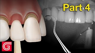 HOW TO TryIn Zirconia Crowns BEFORE Final Cementation [upl. by Notslah168]