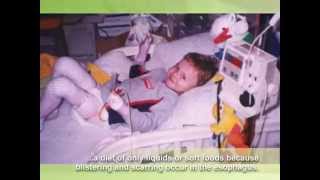 Epidermolysis Bullosa EB Awareness video extended [upl. by Ydoc369]