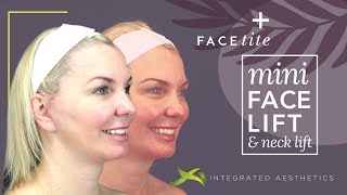 Mini facelift and neck lift using Inmode facetite device [upl. by Arnold218]