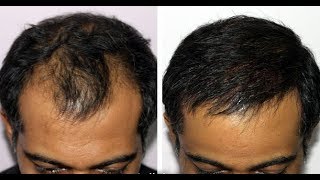 Hair growth with evion and zincovit 100 works Drsiddh zincovit evion [upl. by Enialed]