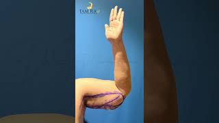 Brachioplasty Before and After  Arm Lift  Tamiralife Chennai [upl. by Eniawtna257]