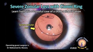 CataractCoach™1810 severe zonular loss with Cionni ring [upl. by Aniret]