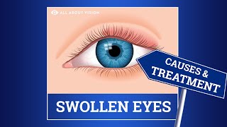 Swollen Eyelid Causes amp Treatment [upl. by Adnauq]