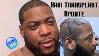 Hair Transplant Results  HT 5 Month Week Update  Afro Hair Type  Istanbul Turkey  Truth [upl. by Northington]