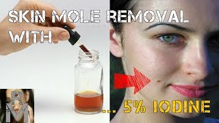 Iodine Mole Removal Treatment Really Works Heres How [upl. by Adnilev628]